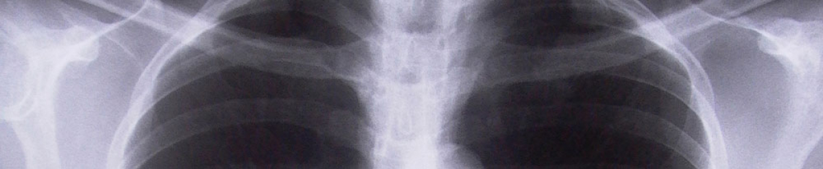 Asfixia y obstrucci&oacute;n de las v&iacute;as respiratorias